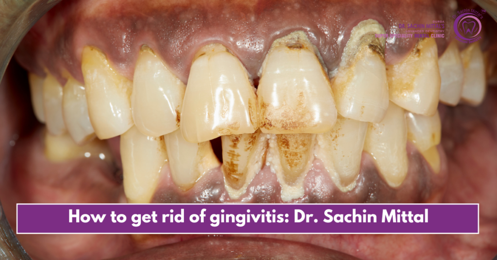 How to get rid of gingivitis: Dr. Sachin Mittal