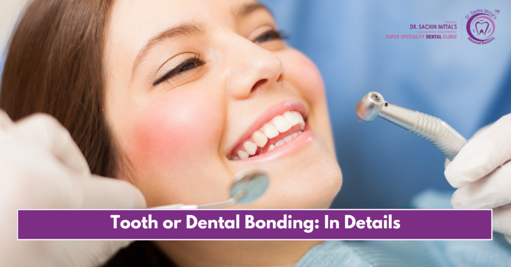 Tooth or Dental Bonding: In Details