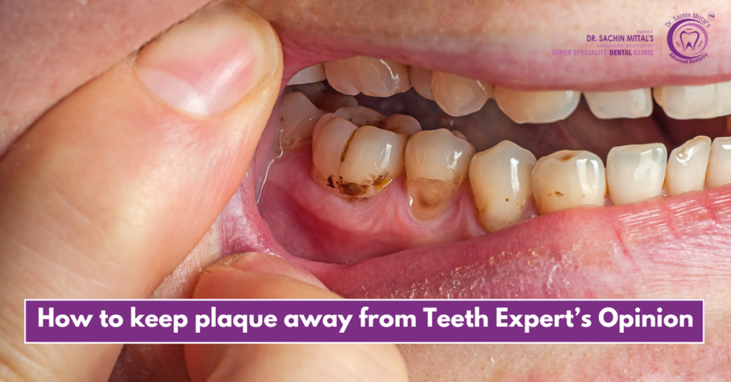 How to keep plaque away from Teeth Expert's Opinion