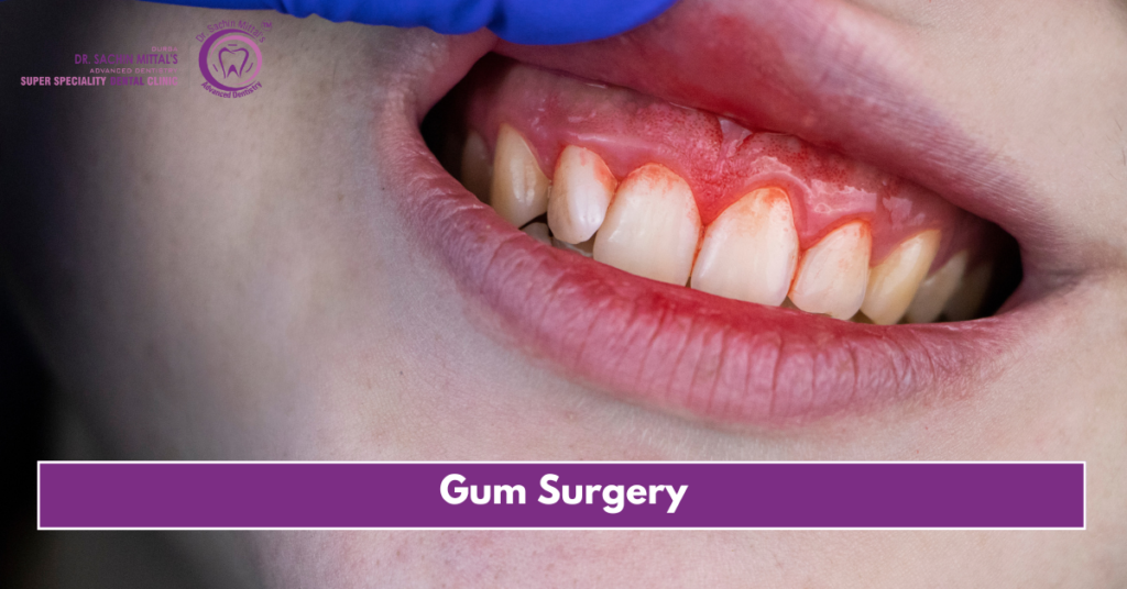 Gum Surgery