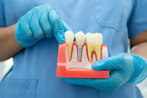 Dental Implants