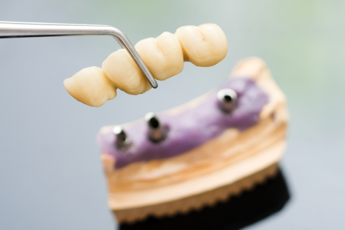 Dental Crown and Bridge