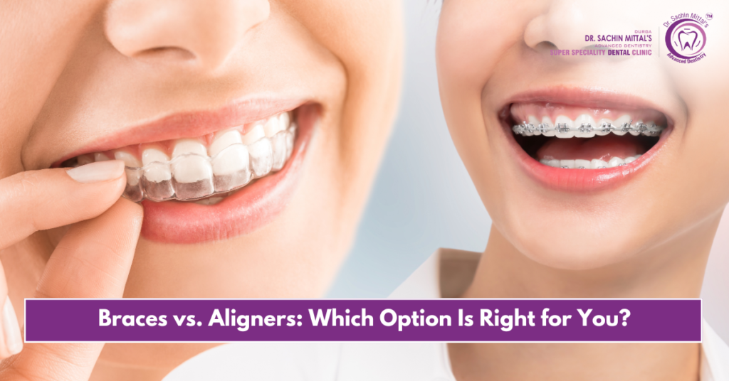 Braces vs. Aligners: Which Option Is Right for You?